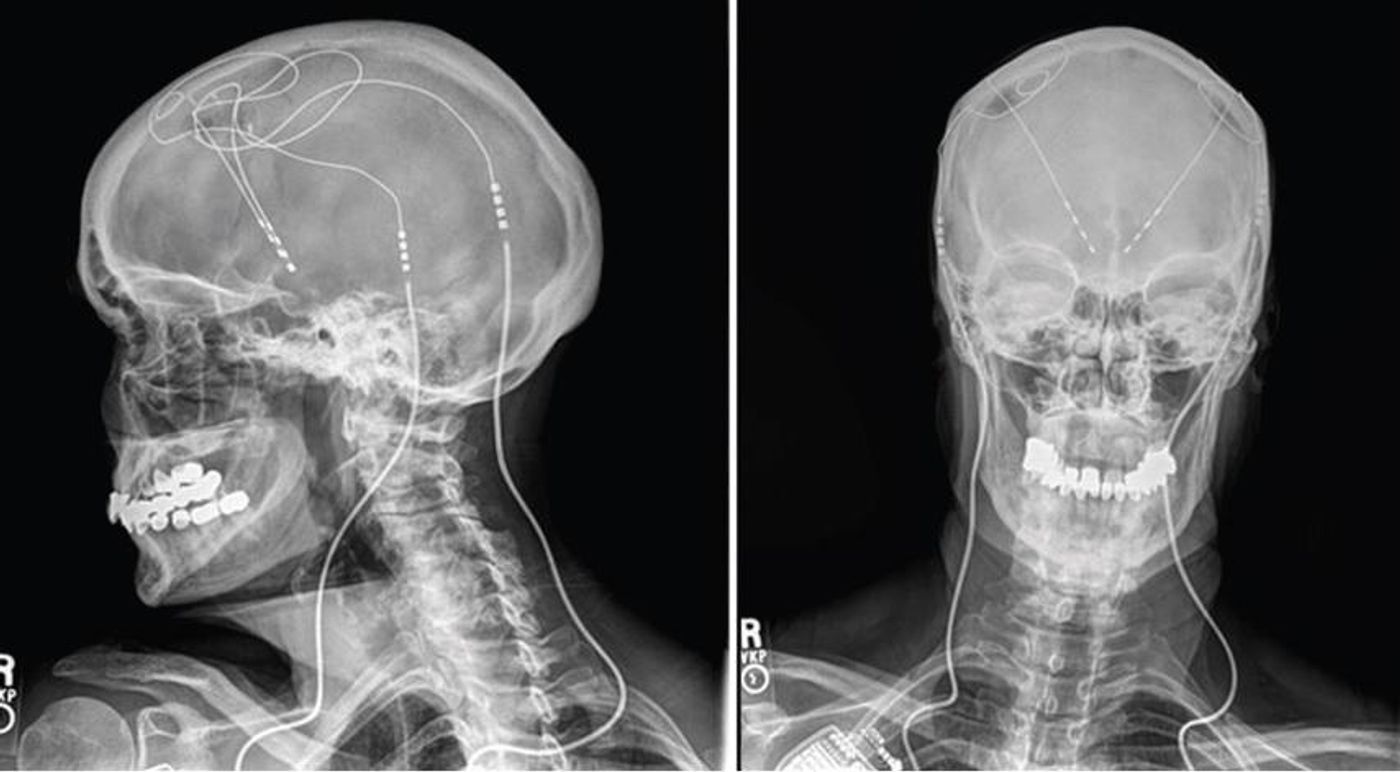 X-ray of DBS patient, credit: Ohio State University Wexner Medical Center