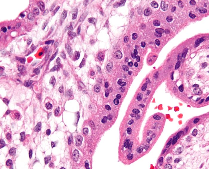 Micrograph showing chorionic villi of placenta with Hofbauer cells