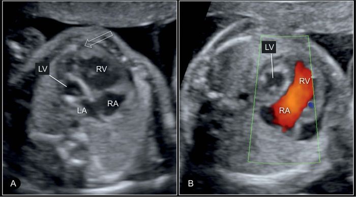 Four-chamber view of a hypoplastic left heart syndrome at 22 weeks' gestation in 2D (A) and color Doppler (B) imaging. Credit: Obgyn Key