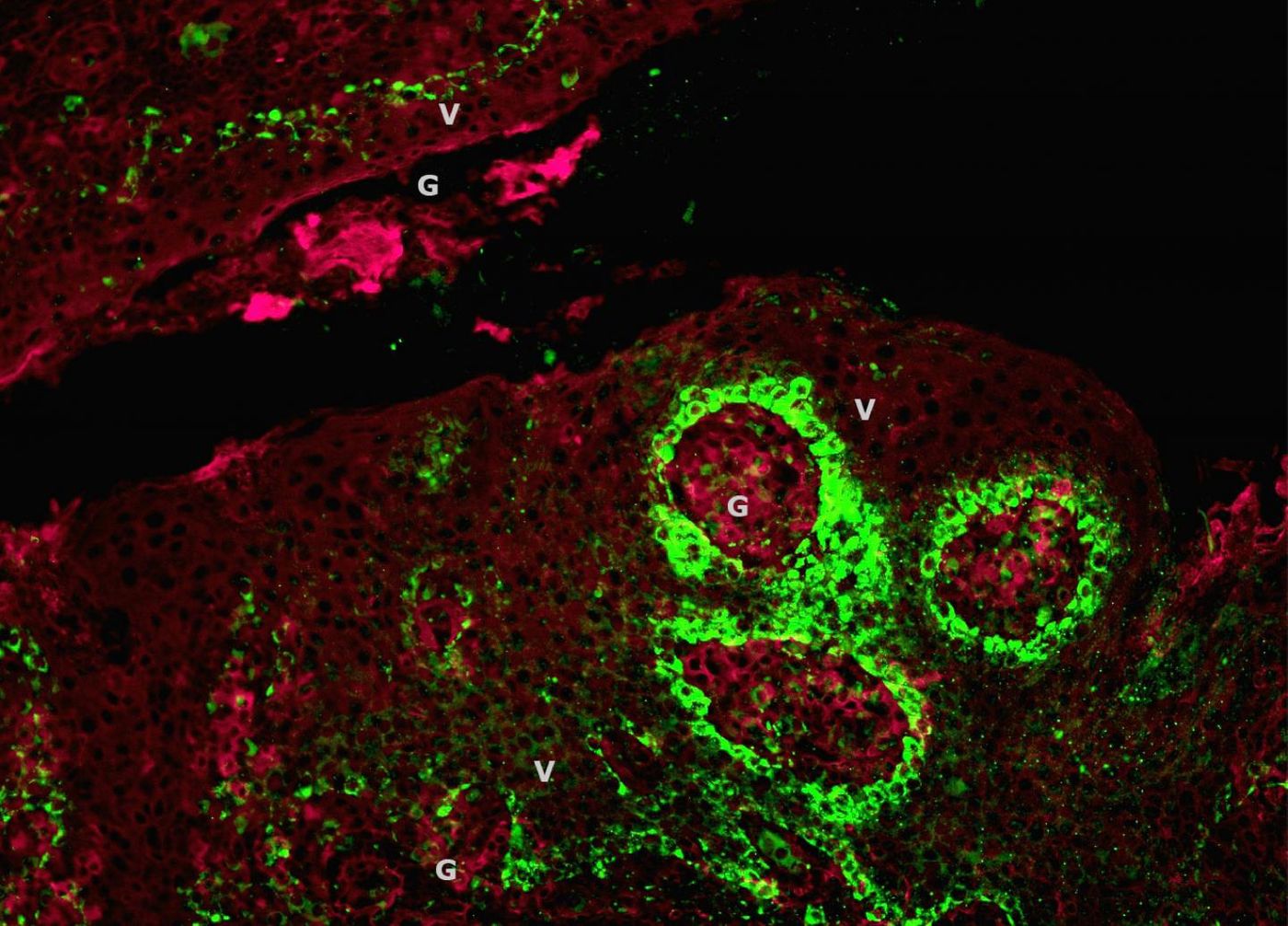 These are tonsil crypts with human papillomavirus (HPV; green) in epithelial and biofilm (red) layers ('V' = biofilm; 'G' = HPV). Credit: Katherine Rieth, MD