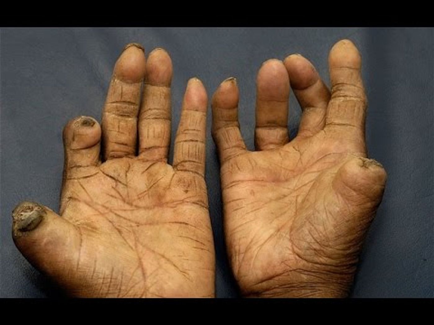Leprosy damages fingers and toes