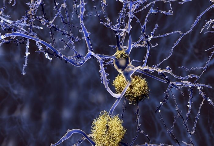 Amyloid plaque clumps (yellow) in the brain