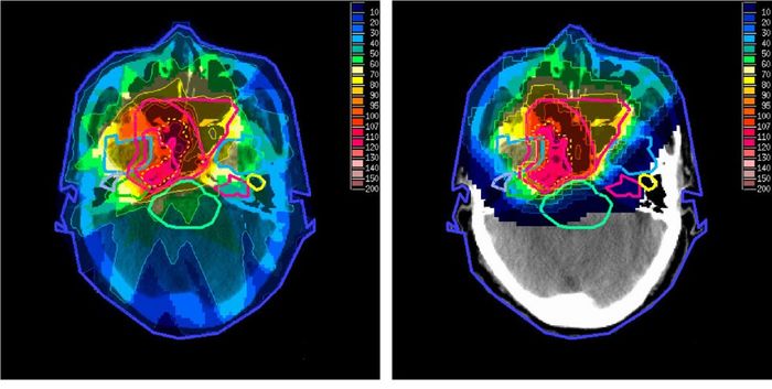 Study questions effectiveness of brain radiotherapy for lung cancer patients | Image: wikipedia.org