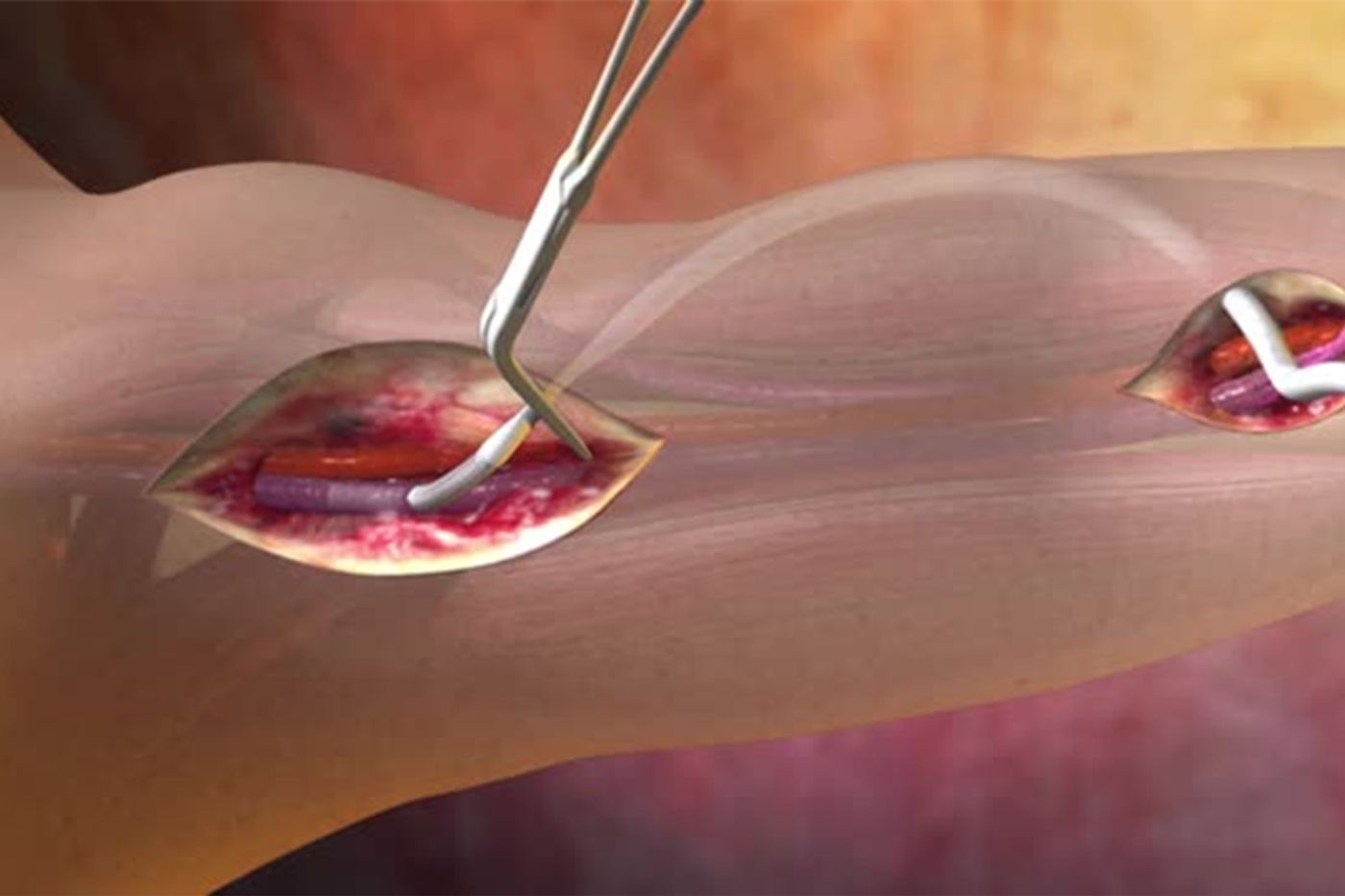 An animation of a vascular graft standard procedure. Source: Gore Medical