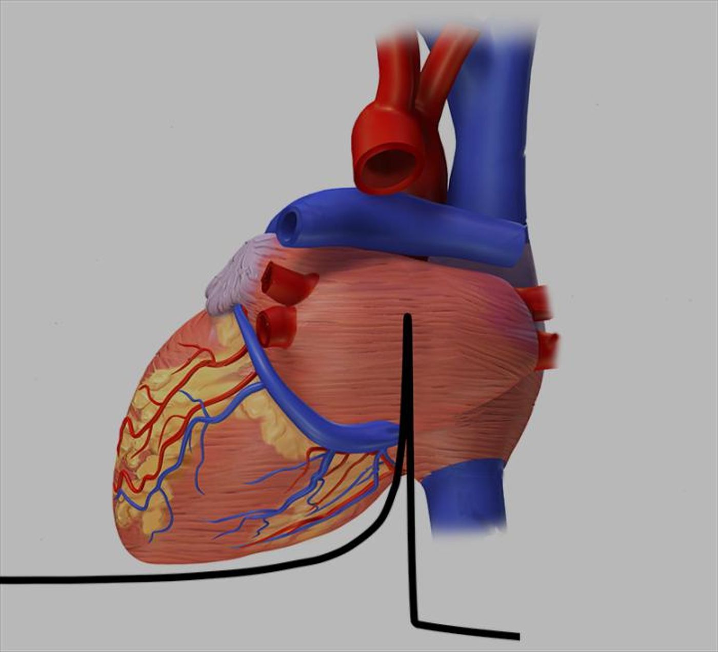 The treatment of cardiac arrhythmia with ions is studied at GSI. Therefore certain areas of the cardiac tissue are irradiated. In the area of the Bragg peak (black) ions deposit their energy and the tissue becomes deserted. Credit: Blausen.com staff. CC BY 3.0, remix by GSI