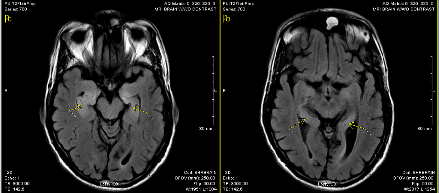 MRI in Encephalitis. Areas of increased signal intensity are noted in the hippocampi. The right side is slightly thickened.