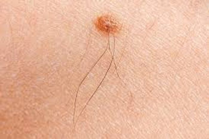 New research suggests hair follicles could act as origin points for melanoma. Photo: cullmandermatology.com