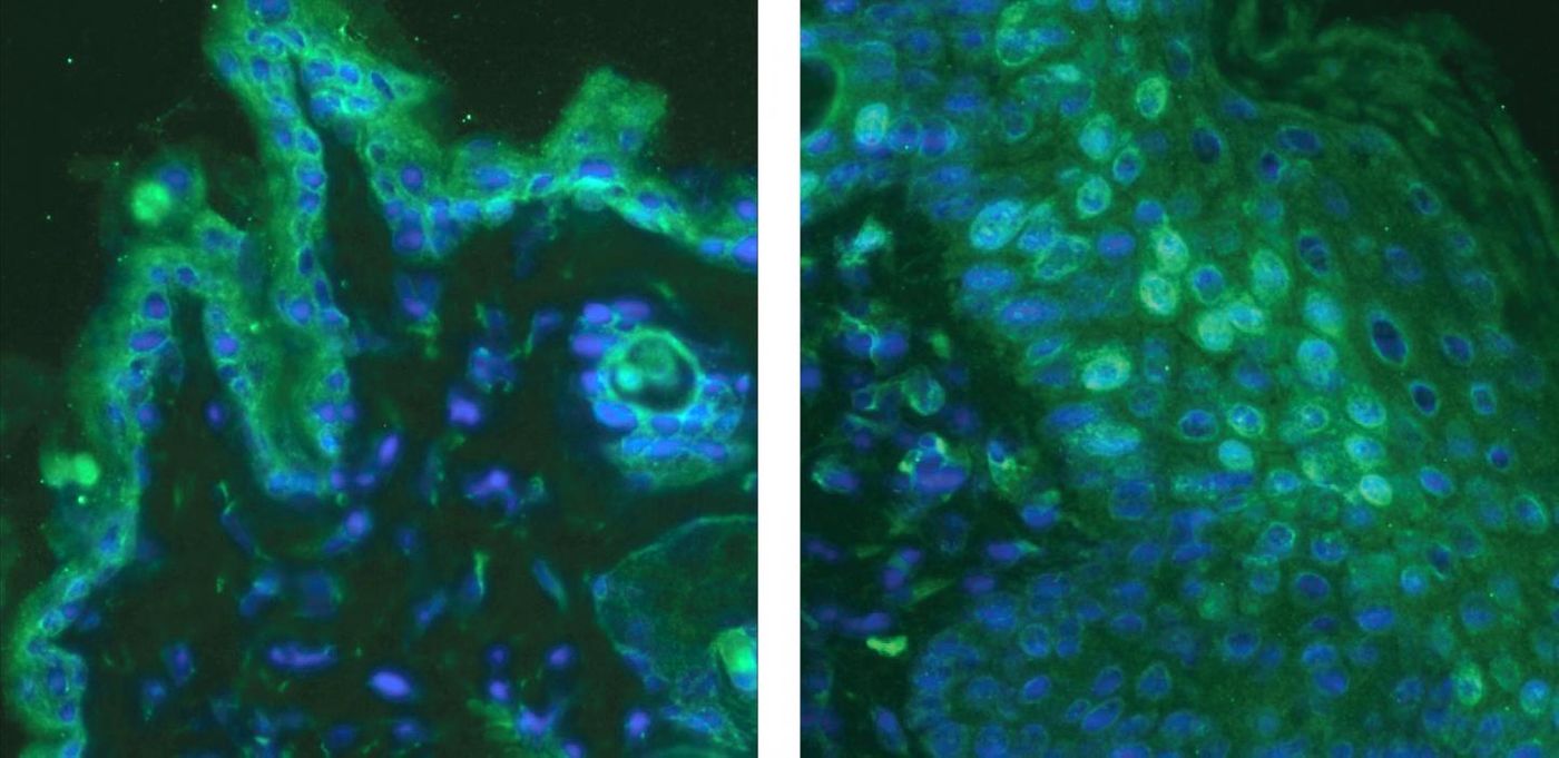 A fluorescence microscope image shows the skin of a healthy mouse (left) and skin from a mouse with a poison ivy rash (right). Interleukin-33, shown in green stain, is a protein that acts directly on the nerves, telling the brain the skin is extremely itchy. / Credit: Sven-Eric Jordt/Duke Health