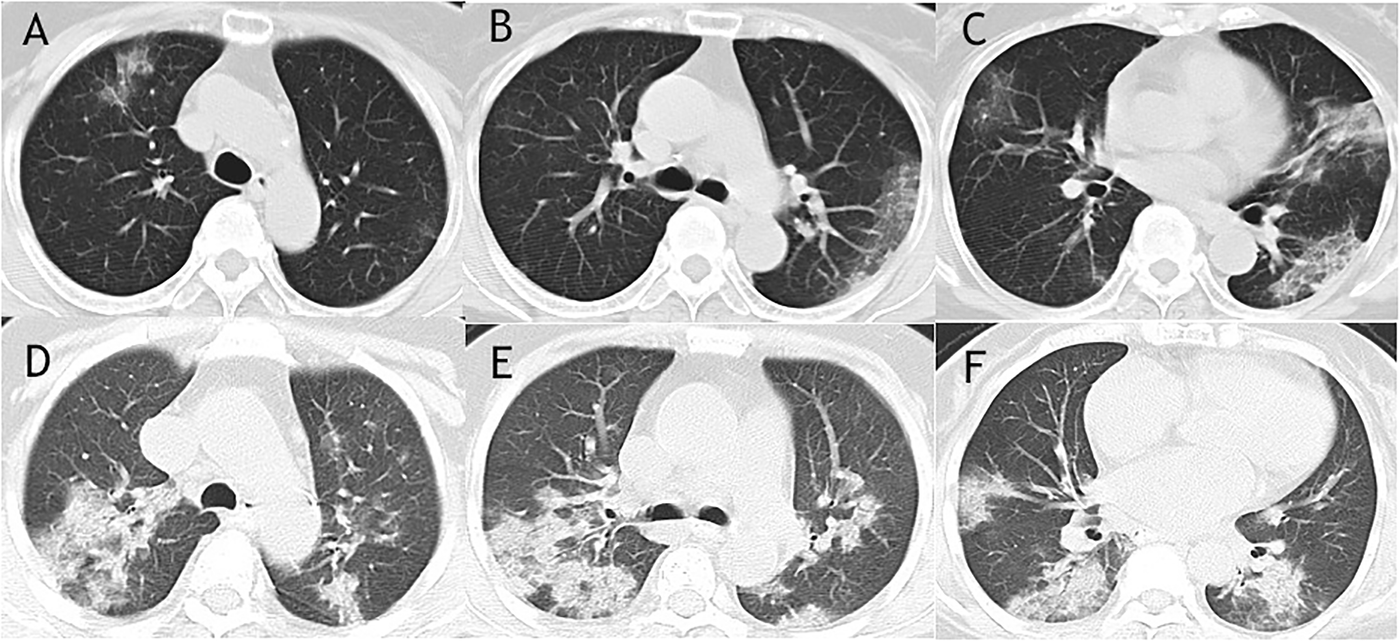 "Comparison of CT images between survival group and mortality group". A,B, and C represent the survival group. D,E, and F represent the mortality group.