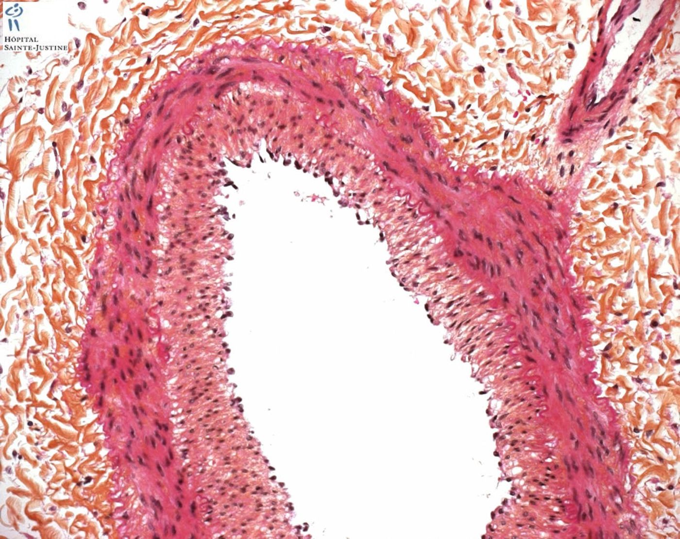 Intimal fibrosis in pulmonary artery. Source: Humpath.com