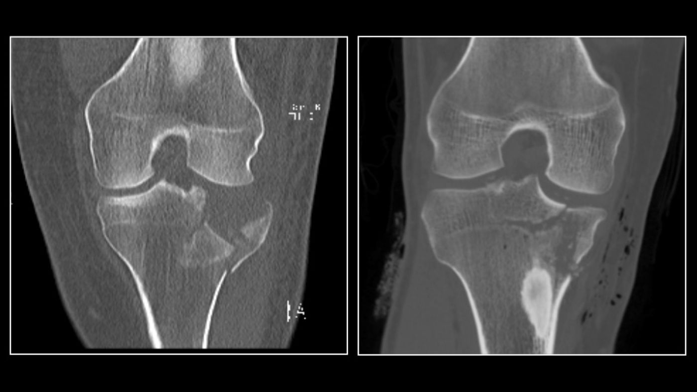 This is an ultra-low dose radiation CT scan of a fracture of the tibial plateau (left) compared to a conventional dose CT scan.