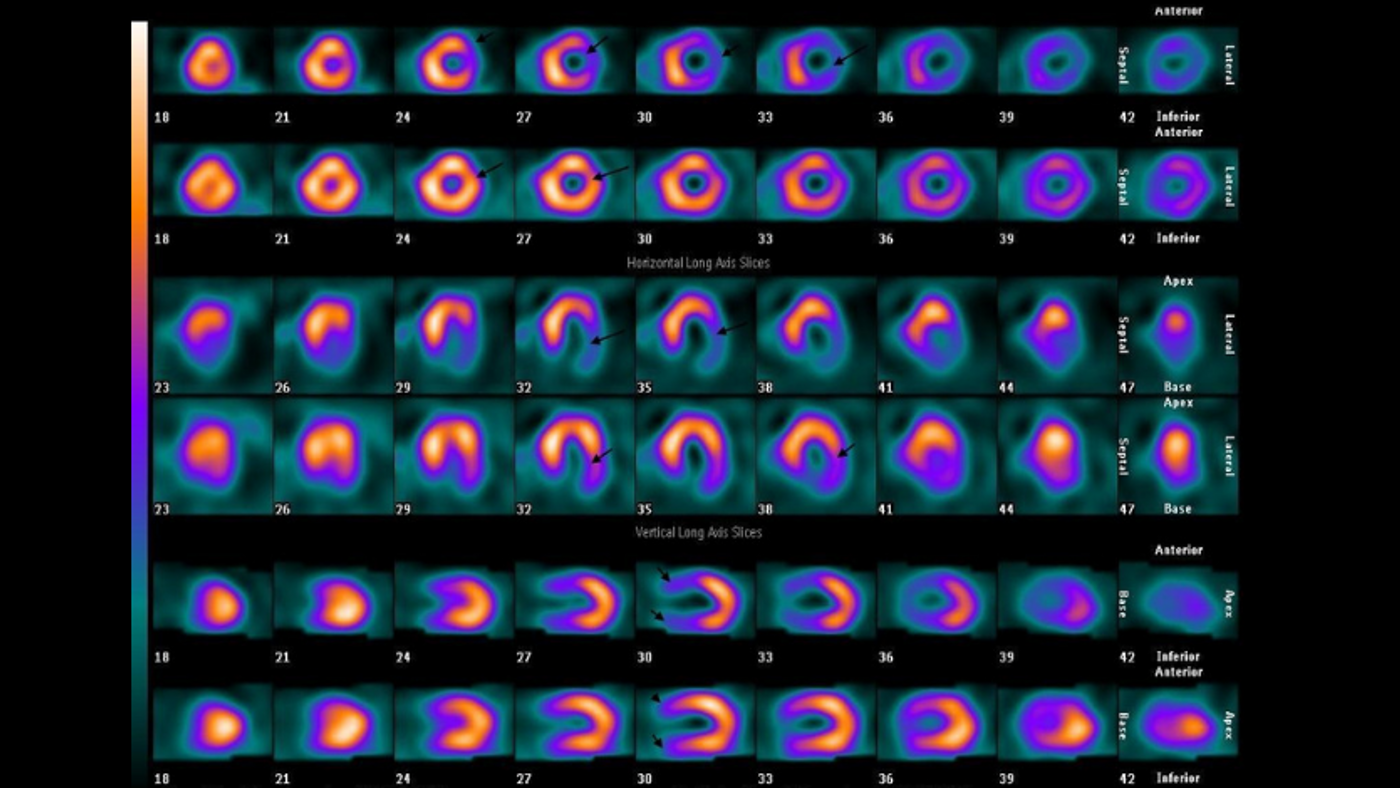 SPECT images of a myocardial perfusion scan (WikiMedia)