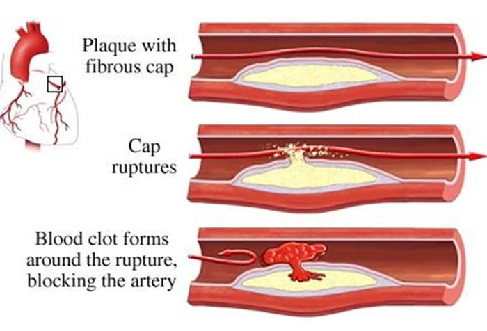 Large Artery Thrombosis