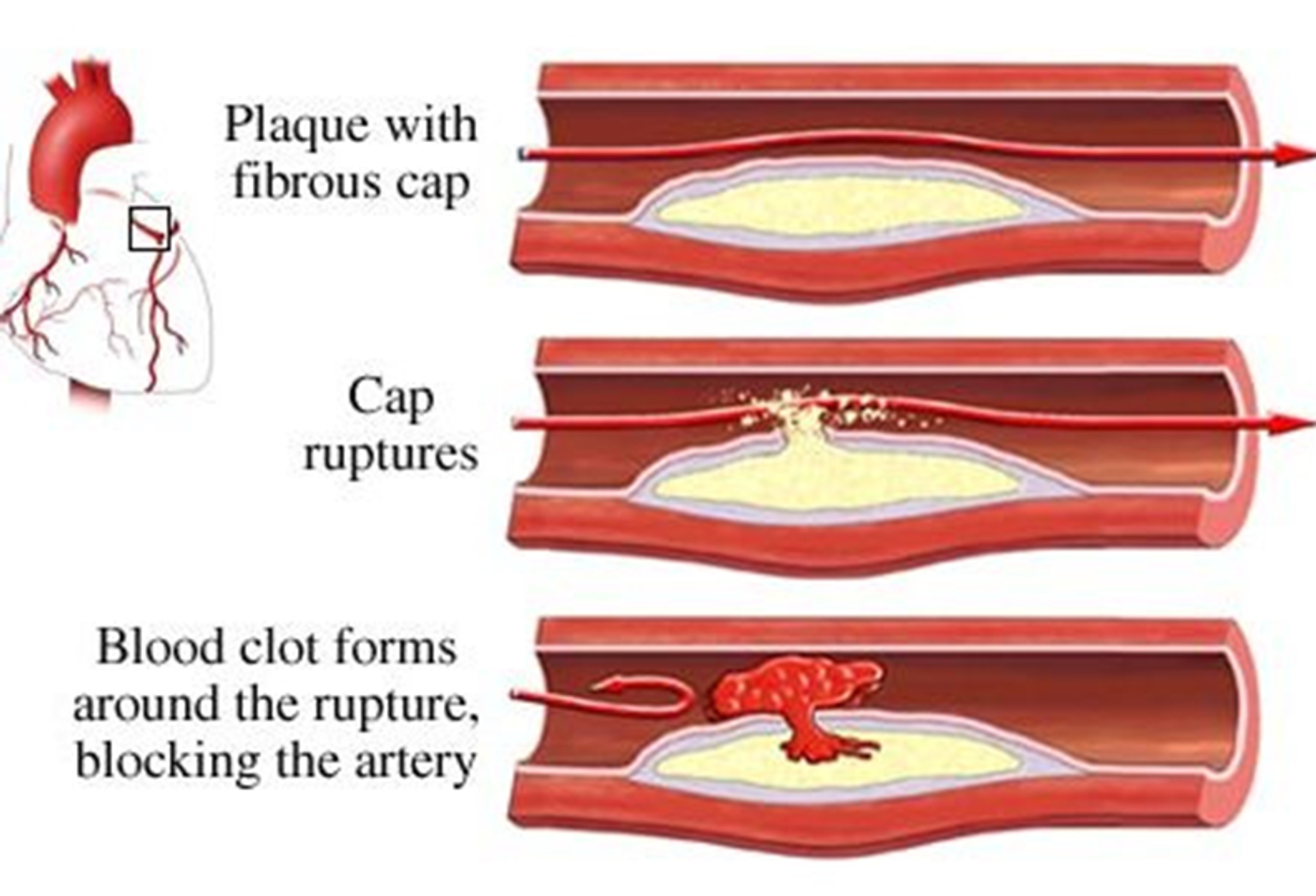 Blood Clot And Healthy Artery. Plaque Rupture And Blood Clot