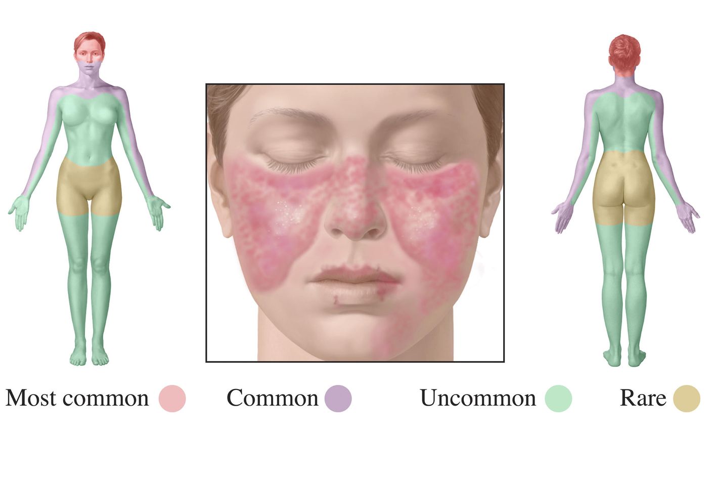 Visualizing the effects of lupus
