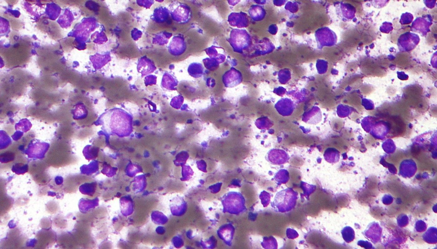 Micrograph of a diffuse large B cell lymphoma, abbreviated DLBCL. Lymph node FNA specimen. Field stain. / Credit: Wikimedia Commons Author: Nephron