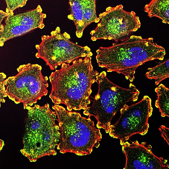 Melanoma cells -podosomes (yellow) nuclei (blue) actin (red) actin regulator (gree) / Credit: NCI