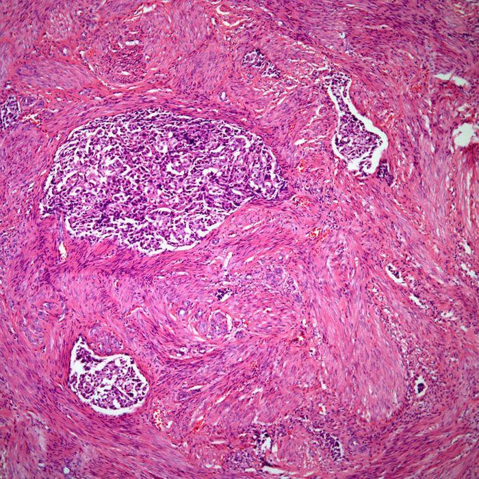 Sections of myometrial muscle infiltrated by metastatic carcinoma. (Cesar A. Moran, CancerNetwork)