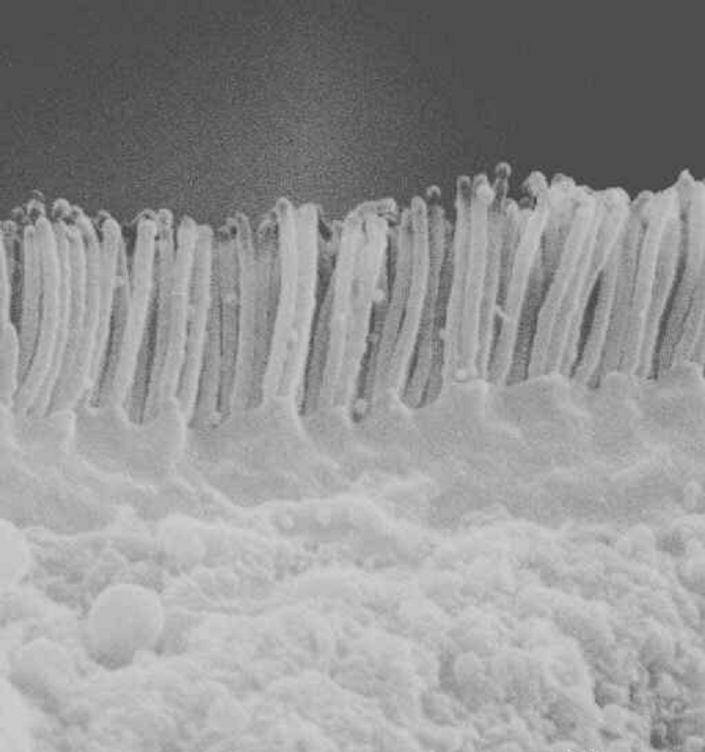 Microvilli inclusion disease (MVID) was found to be associated with a loss of polarity determinants in enterocytes. 