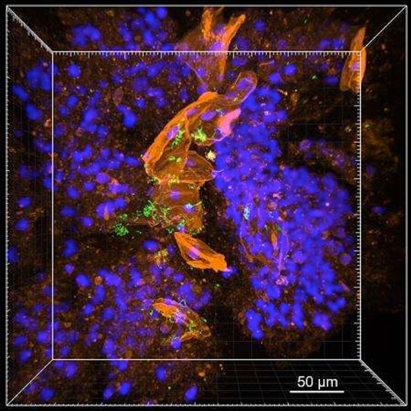 MiPACT-HCR, a tissue clearing technique designed for bacterial retention and identification, was applied to a sputum sample from a CF patient. Confocal microscopy of cleared sputum revealed that Streptococcus (green) aggregated around host cells stained with WGA lectin (orange). DAPI (blue) is host cell nuclei. / Credit: Gradinaru and Newman Laboratories/Caltech