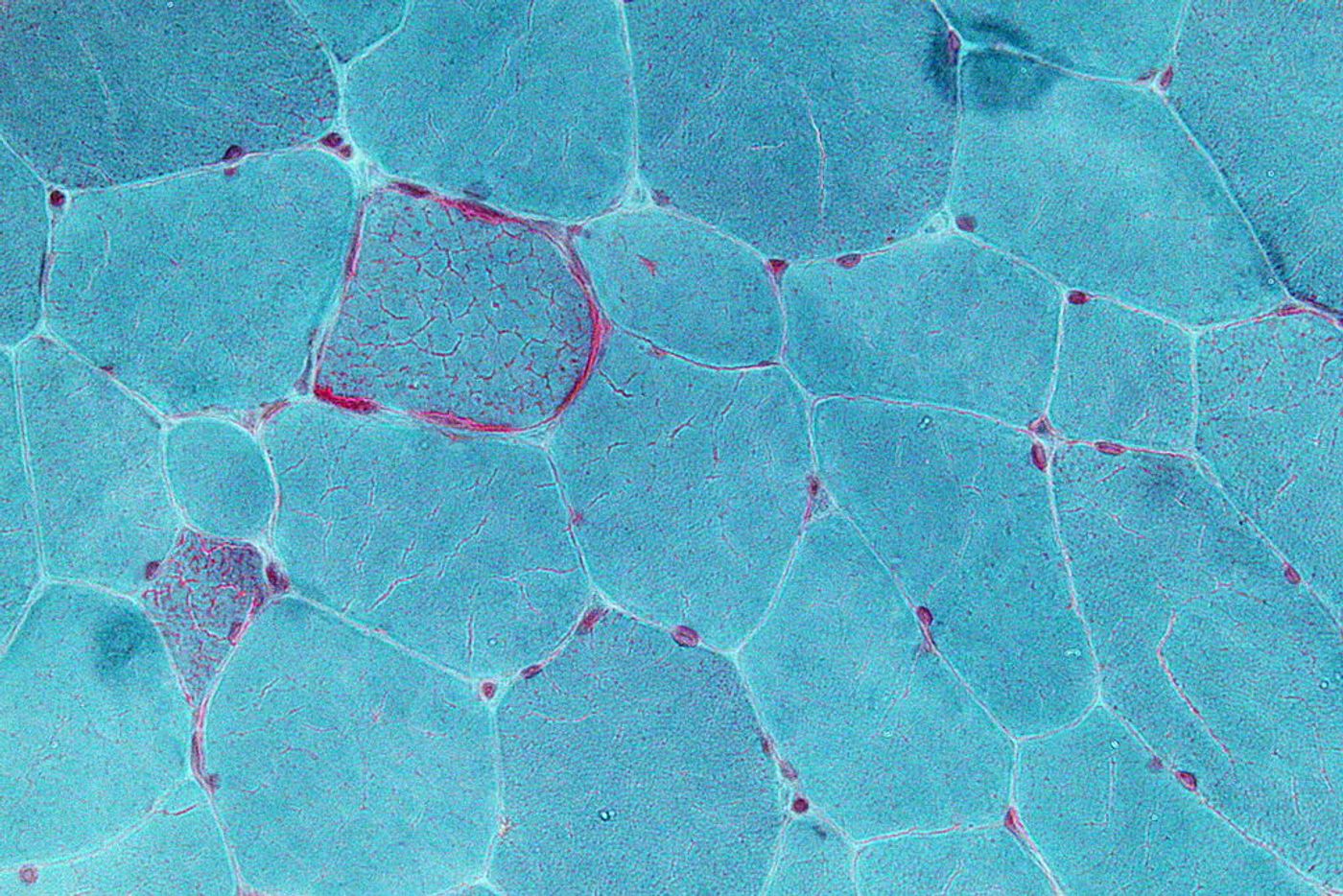 Very high magnification micrograph showing ragged red fibres (also ragged red fibers), commonly abbreviated RRF, in a mitochondrial myopathy. Gomori trichrome stain.