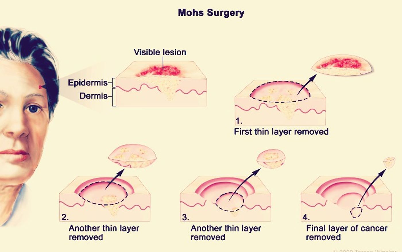 Diagram of MMS, credit: National Center for Biotechnology Information