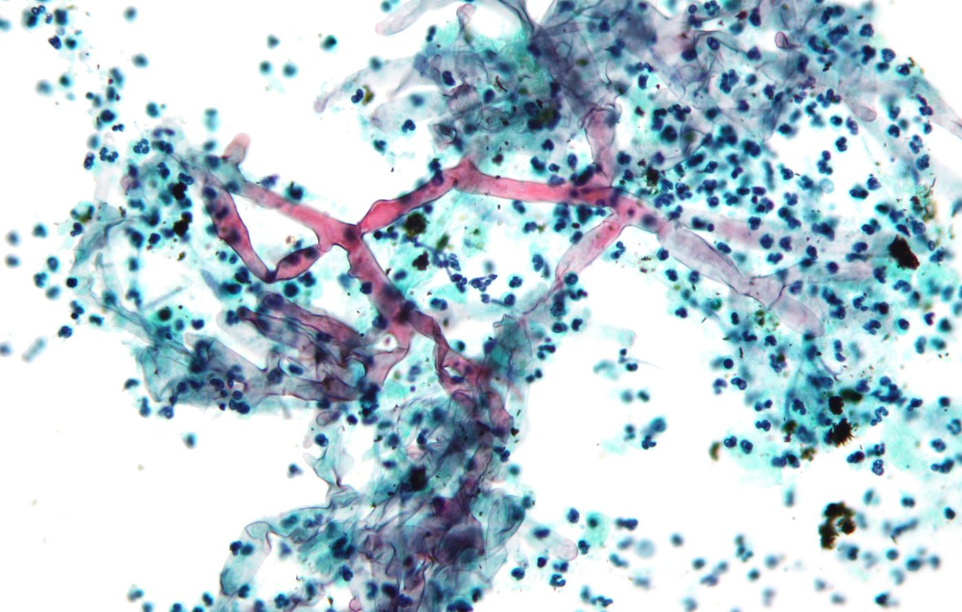 From Wikipedia, a micrograph showing mucorales and demonstrating the characteristic variation thickness.