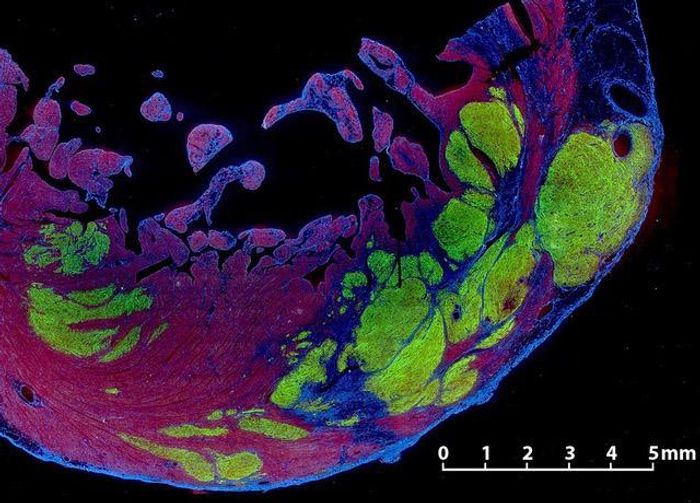 Stem cell-derived human cardiomyocytes (green) integrated into the scarred area (blue) of a heart wall (red). Credit: Xiulan Yang/Murry Lab