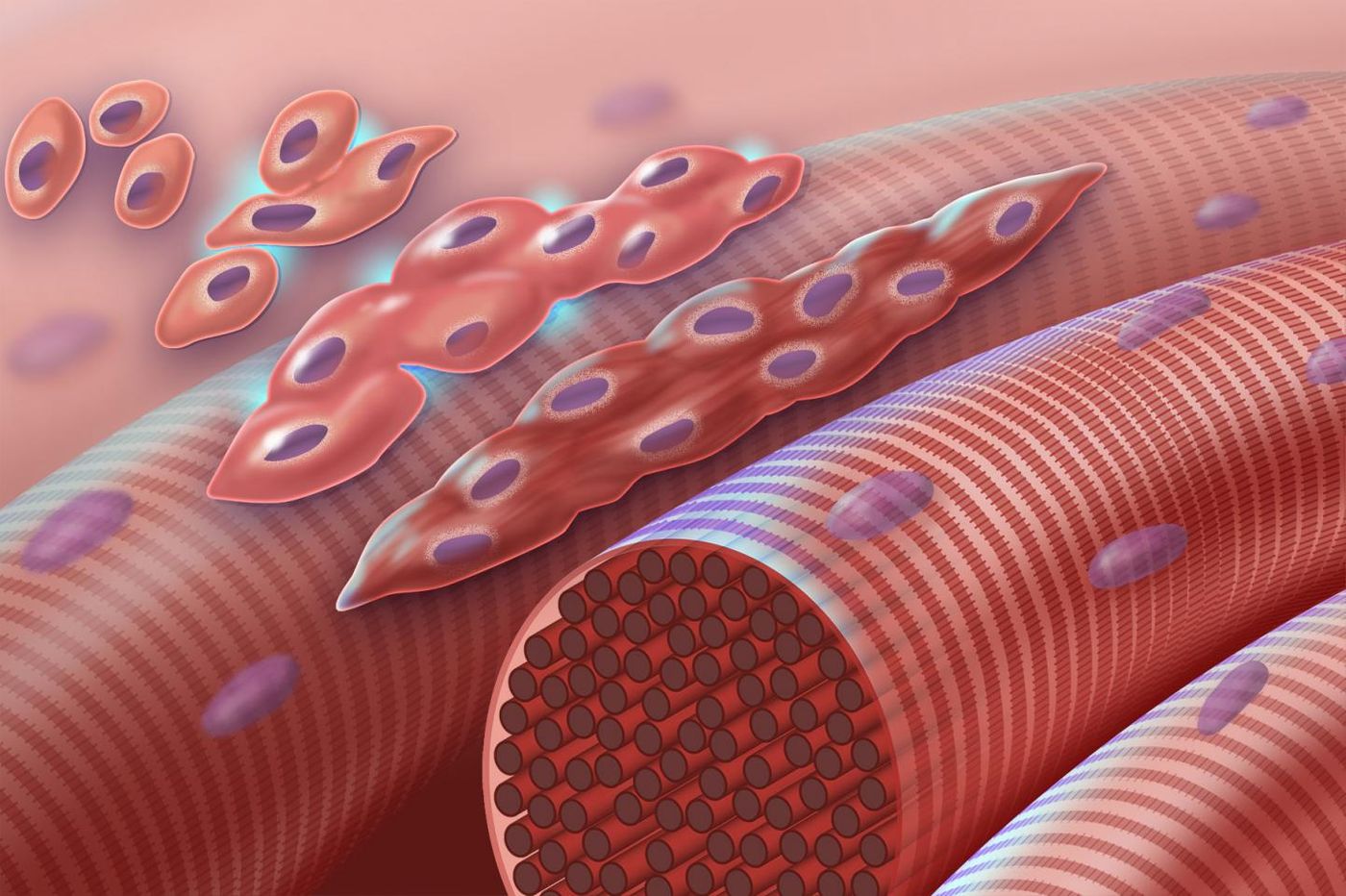 The graphic depicts normal myoblasts (early muscle cells with a single nucleus) fusing together to form muscle cells with more than one nucleus. The cascade is disrupted in Carey-Fineman-Ziter syndrome, because of a defect in the membrane protein, myomaker, which is required for cell-cell fusion / Credit: Darryl Leja, NHGRI