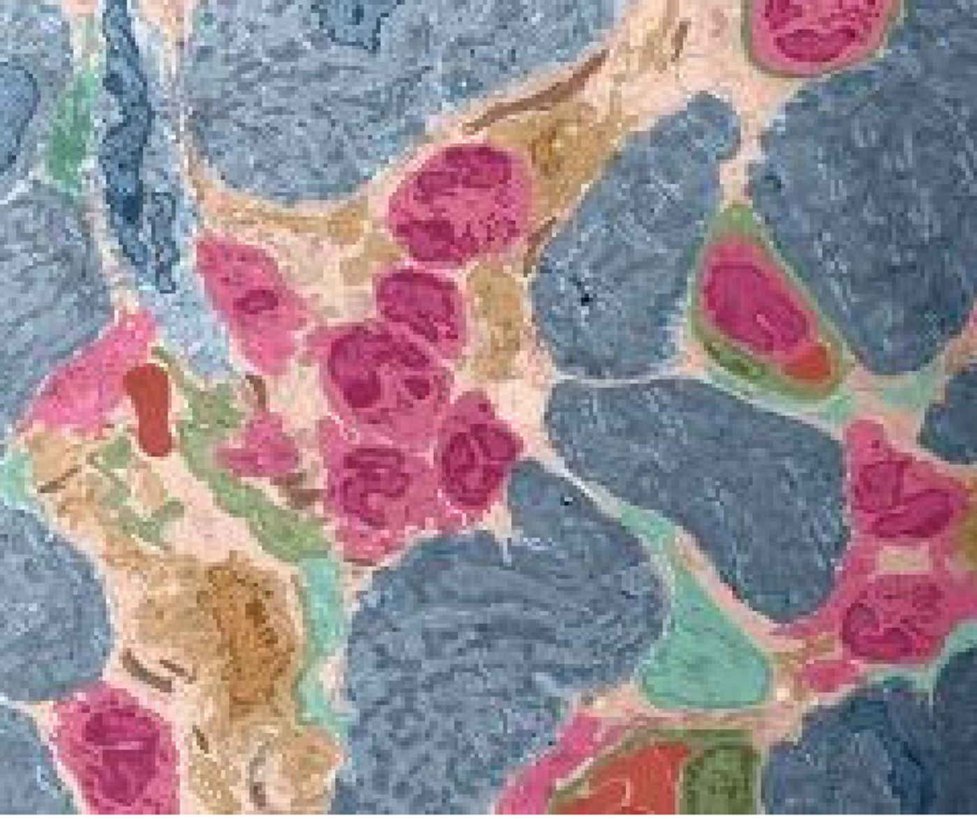 A modified electron microscopy image of eosinophils infiltrating a heart. Eosinophils (pink) can be seen between heart muscle cells (blue) and fibroblasts (turquoise). Eosinophils and other immune cells (orange) exit the blood vessels (green) and infiltrate the heart during myocarditis. 