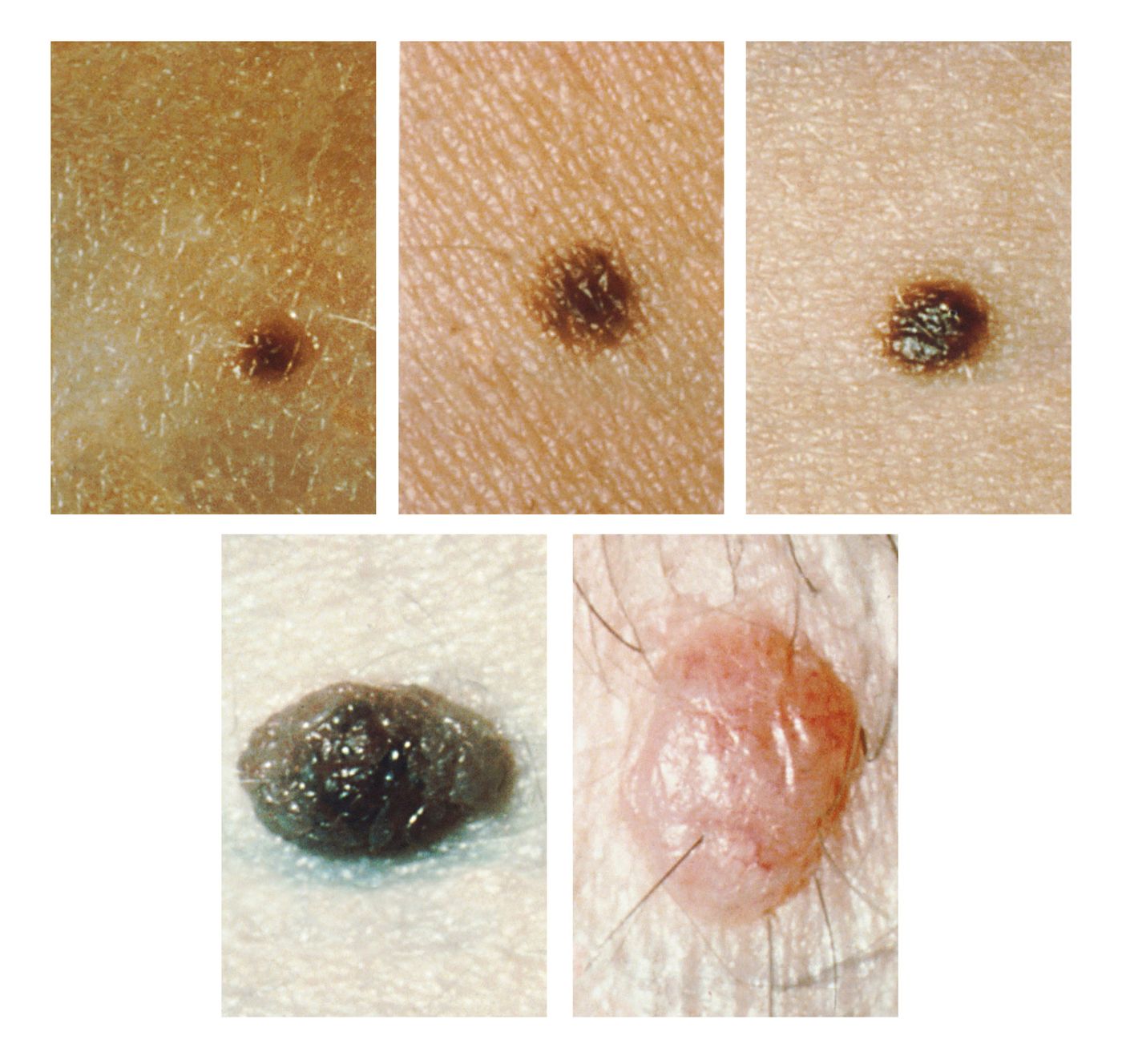 melanoma-zohebamaryss