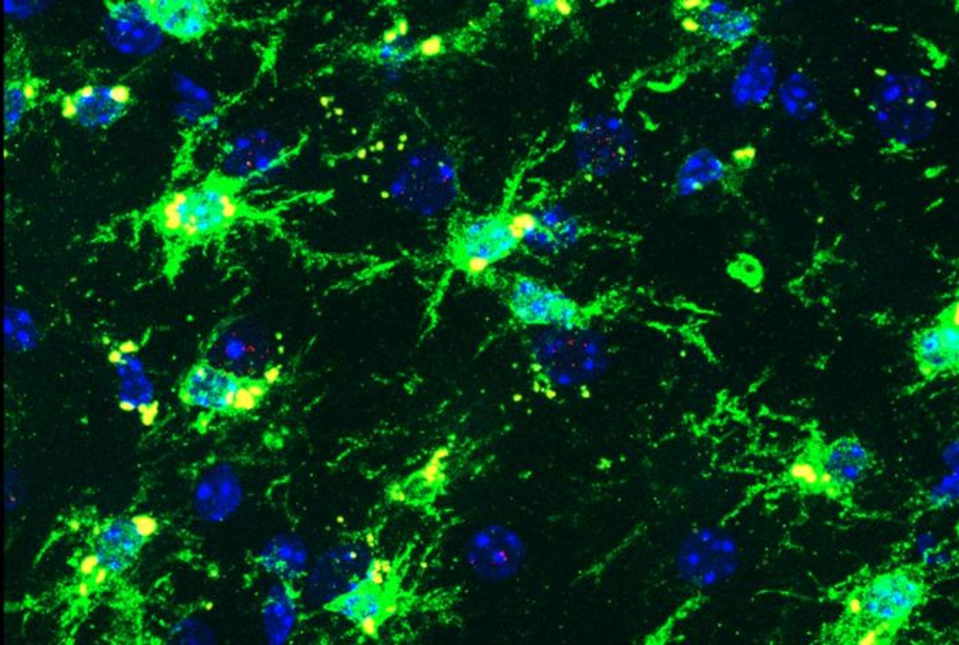 Inflammatory microglia are seen in a female mouse brain, carrying APOE4 and TREM47 R47H, and modeling tau buildup in Alzheimer's disease. Senescent microglia are yellow. / Credit: Gan lab