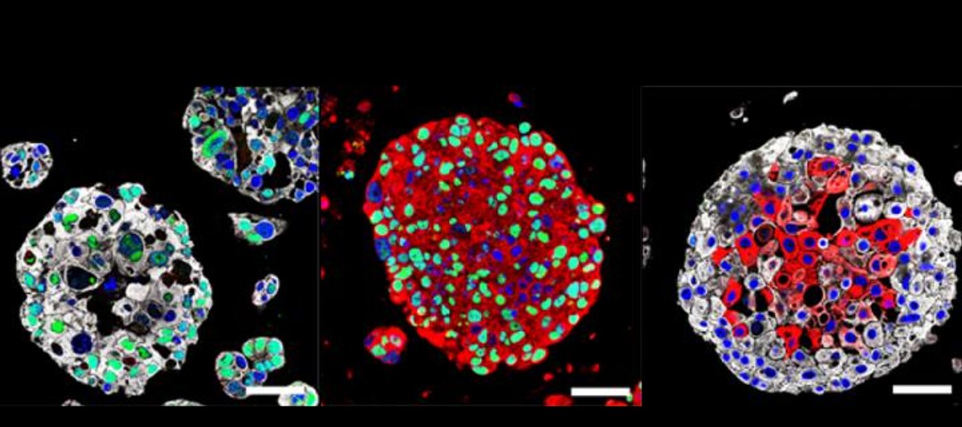 Organoids created from the bladder cancers of patients mimic the characteristics of each patient's tumor and may be used in the future to identify the best treatment for each patient. / Credit: Columbia University Irving Medical Center