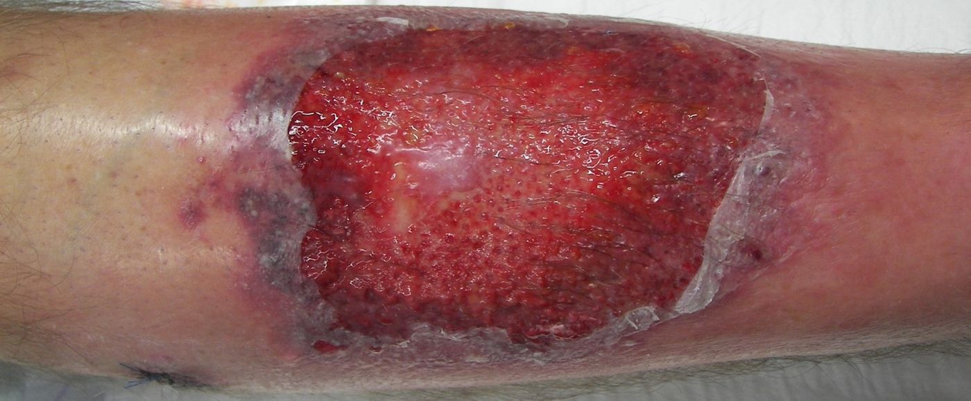 Pyoderma injury, characteristic of PAAND