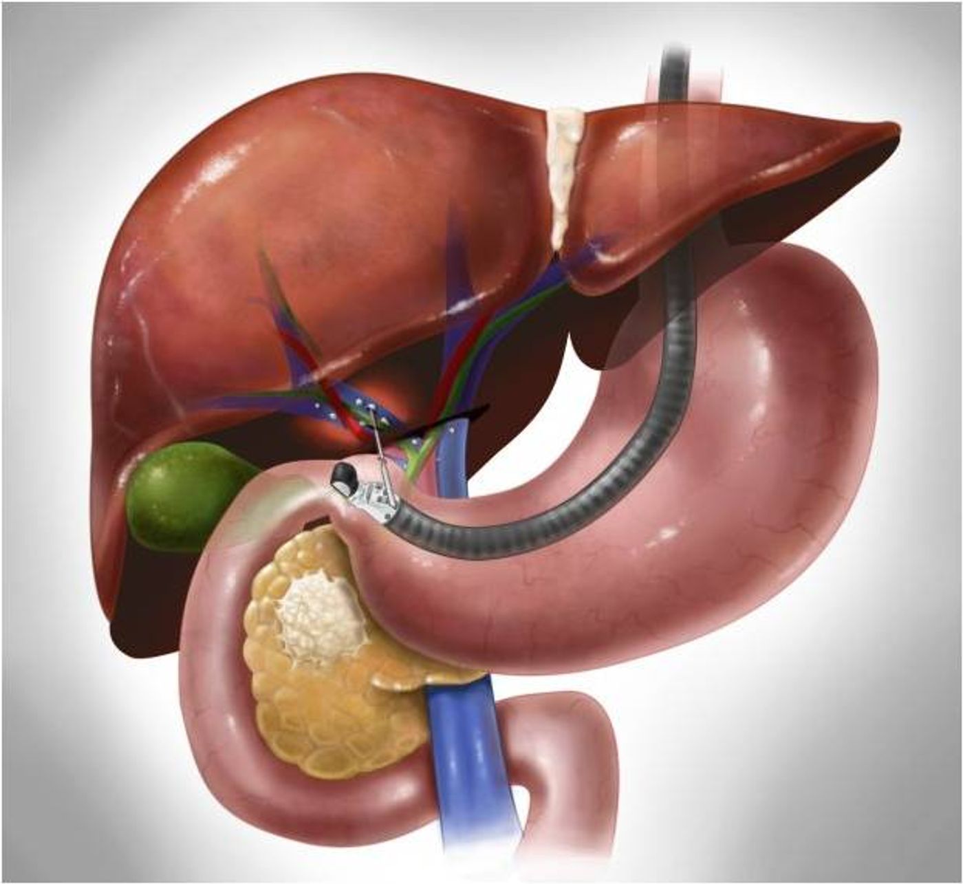 Blood taken from the portal vein detects higher tumor cell counts.