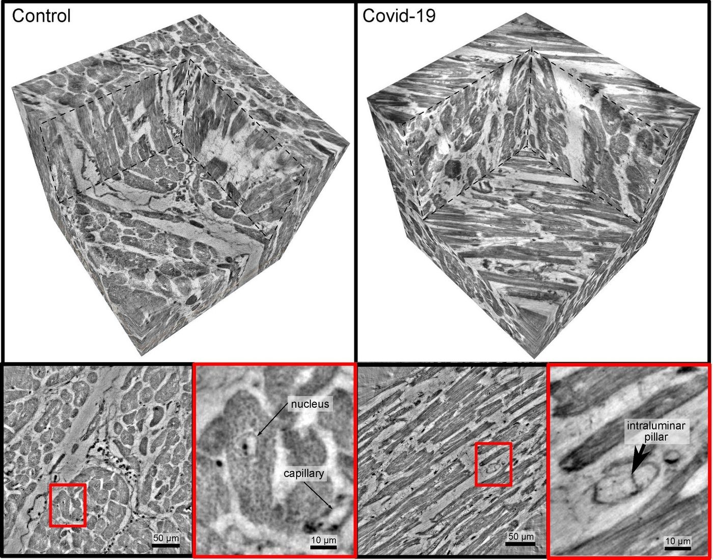 Heart tissue that is healthy (left) or affected by severe COVID-19 (right). Healthy blood vessels are intact (bottom right), but cavities, pouches, and tiny tubular structures formed in capillaries in COVID-19, indicating specific changes. / Photo: M Reichardt, T Salditt