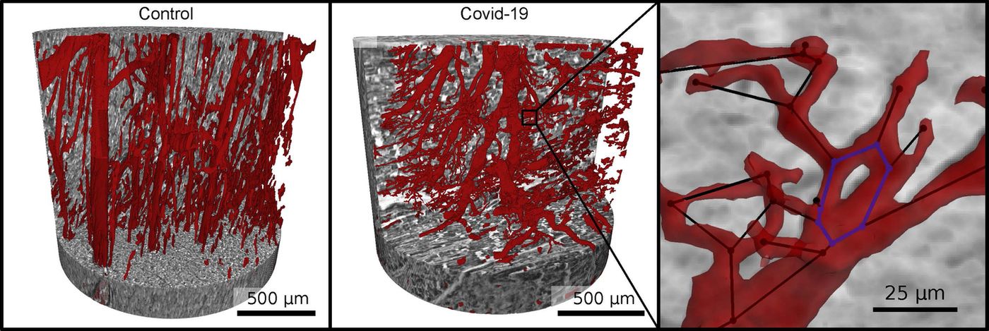 The vascular network (red) of healthy heart tissue (left) and severe COVID-19 (right). COVID-19 causes the faulty reformation of numerous branches, splits and even loops in the capillaries that can be analyzed mathematically. / Photo: M. Reichardt, P. Møller Jensen, T. Salditt