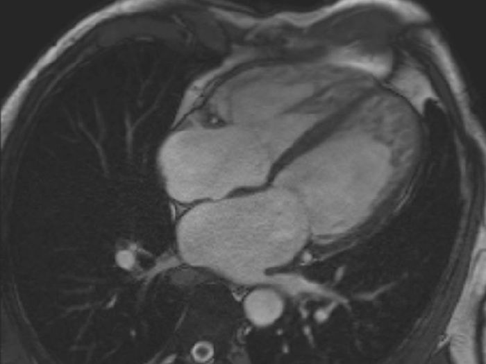 Four chamber image showing dilated left and right ventricles with trabeculation in the RV 'apex', and progressive trabeculation from mid-apical LV. Credit: ANZCMR