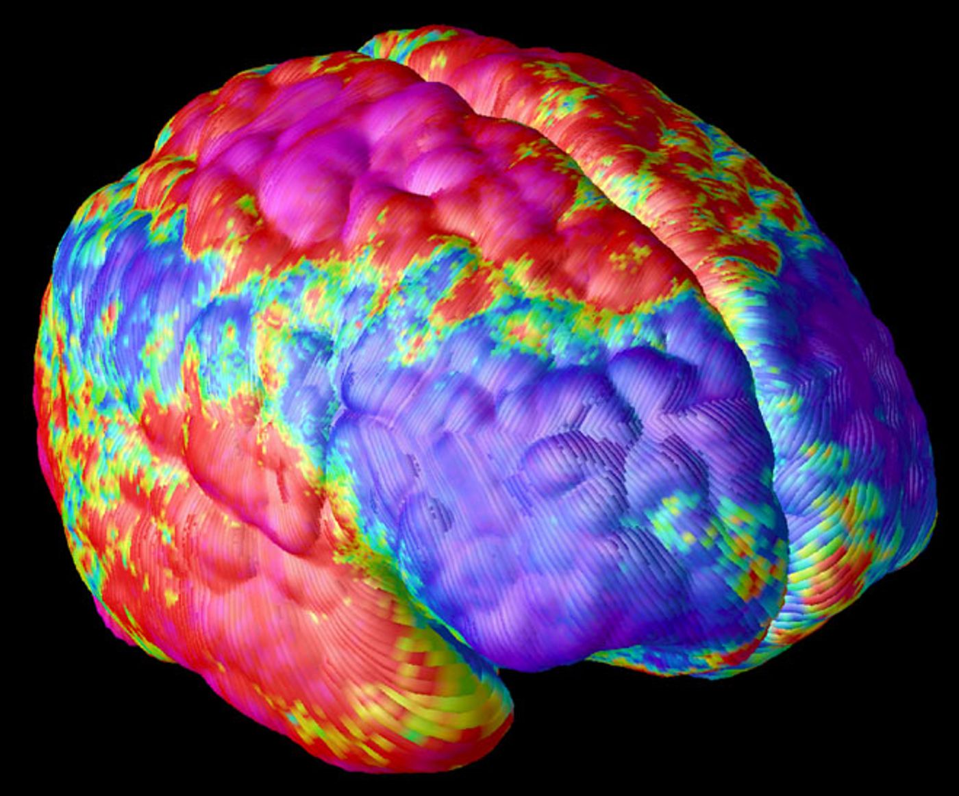 False color image of a Schizophrenic brain. / Credit: NIMH