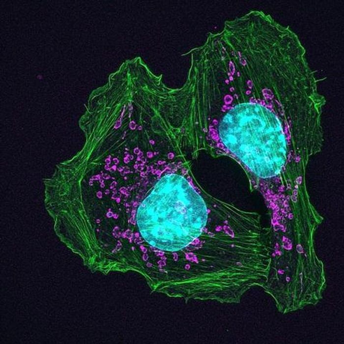This is a skin cancer cell. / Credit: Knight Cancer Institute