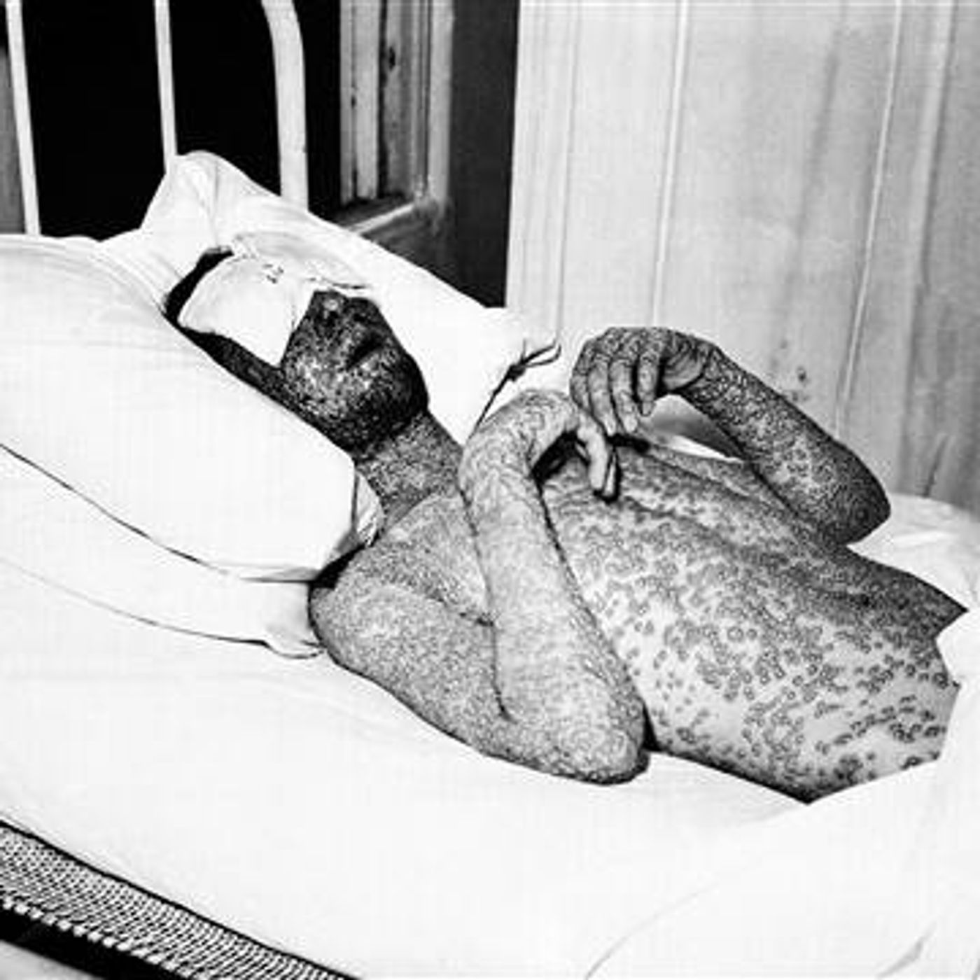 An old photograph of a smallpox patient