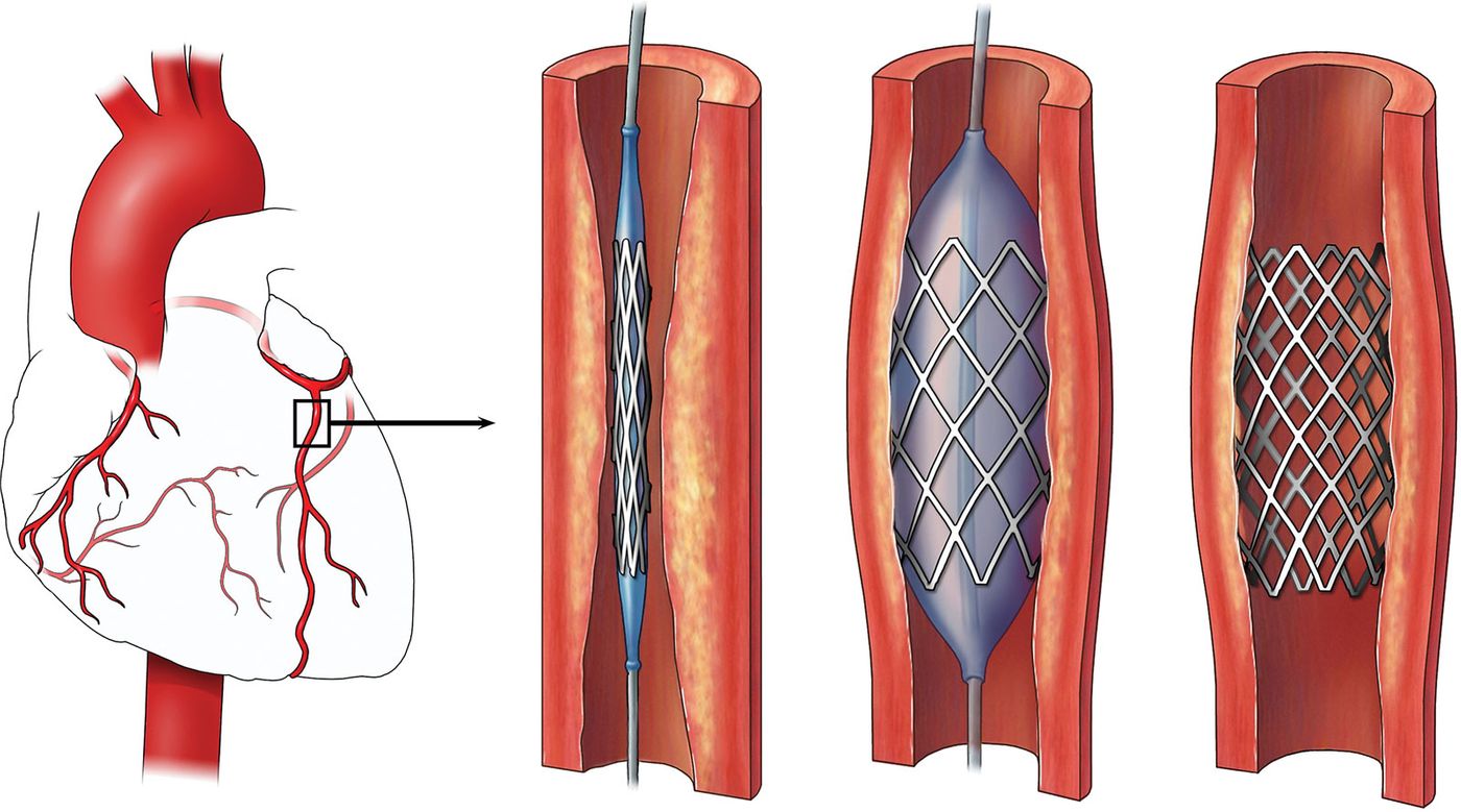 Source: Central Georgia Heart Center