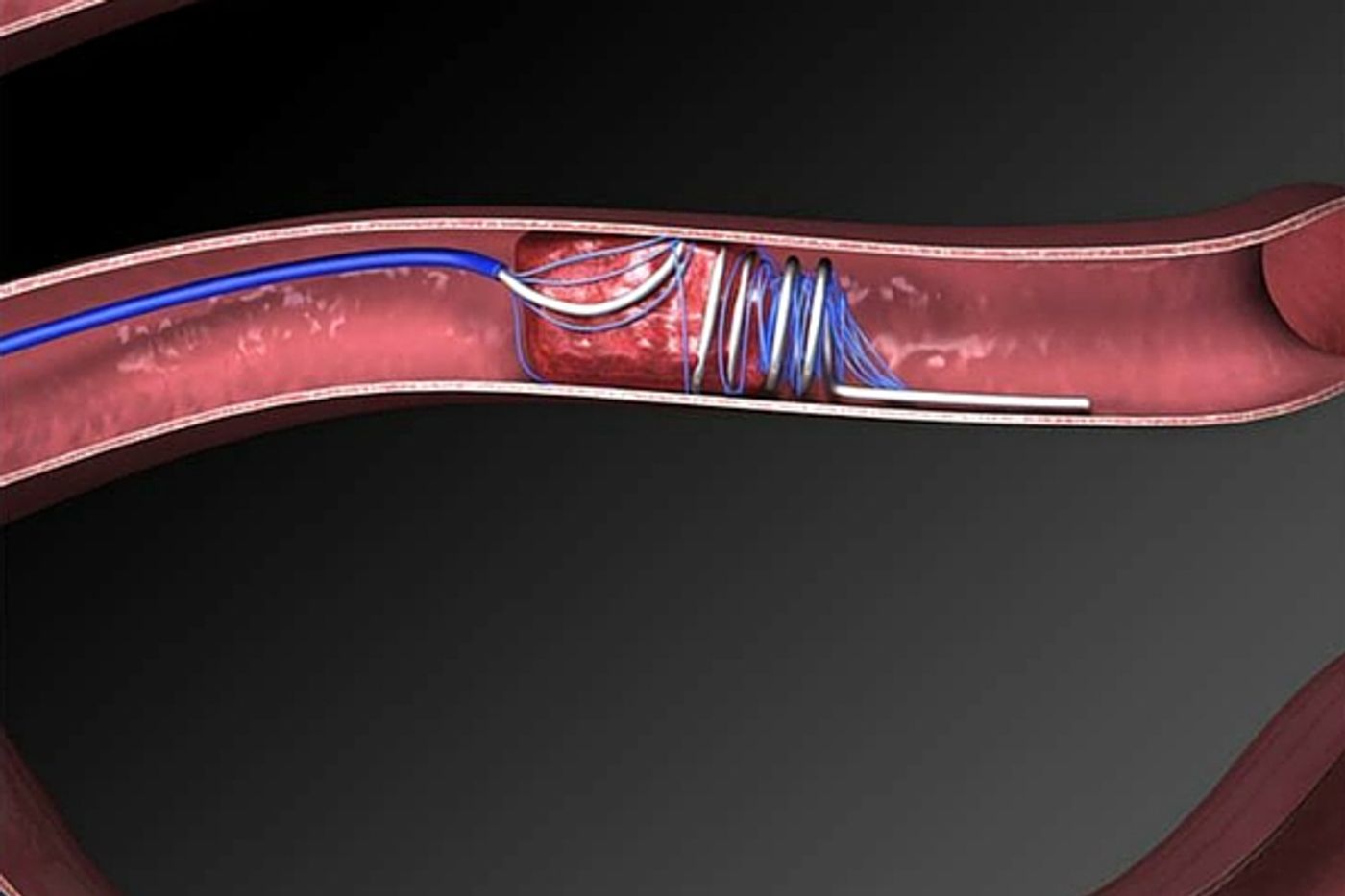 A small device can retrieve a blood clot