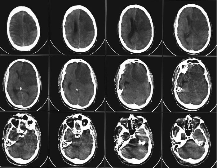 CT scan of a stroke. The patient died a short time after due to brain tissue death and swelling.
