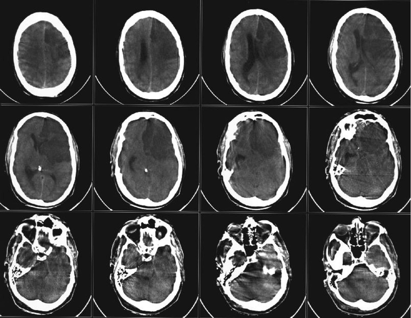 CT scan of a stroke. The patient died a short time after due to brain tissue death and swelling.