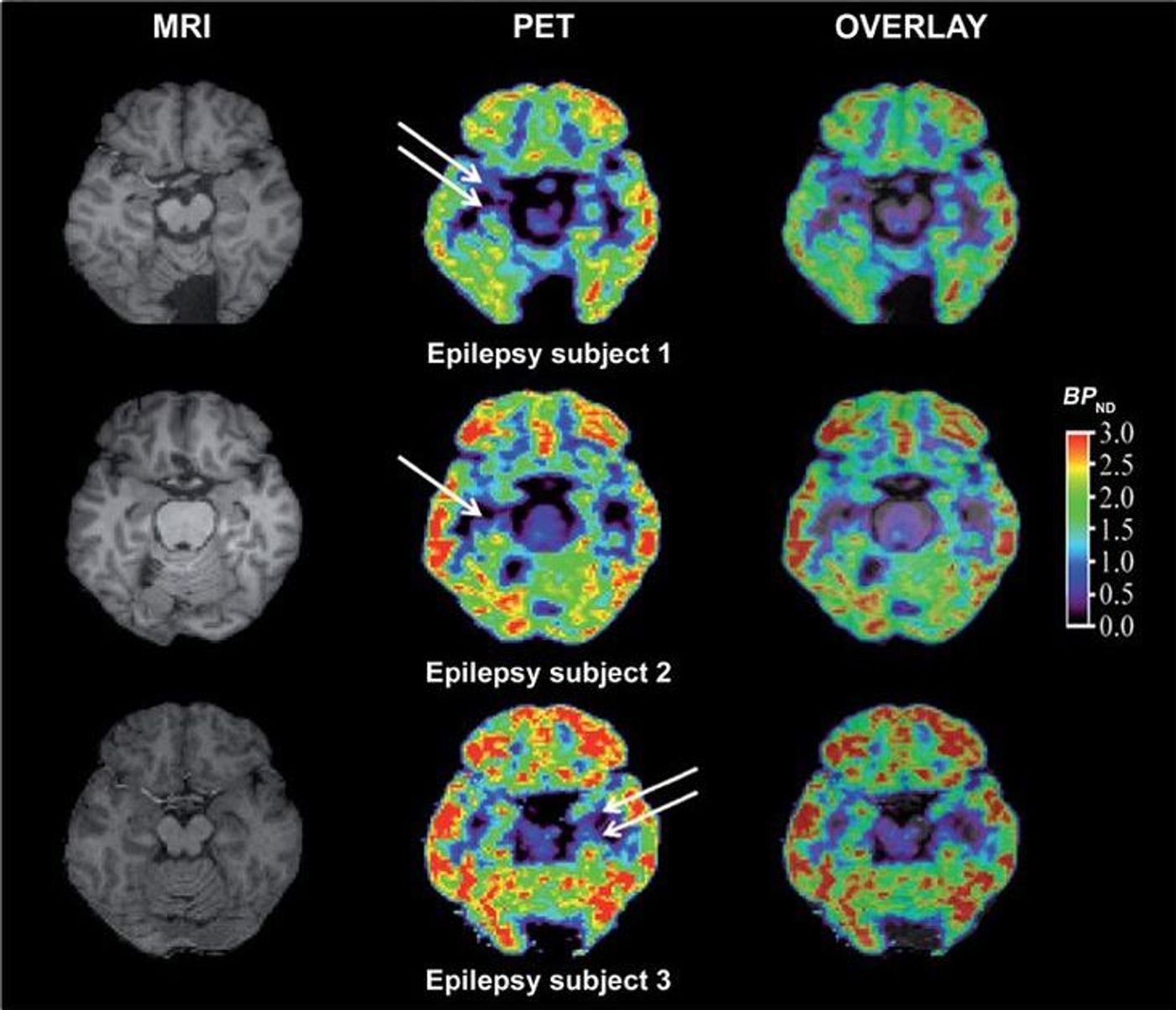 brain pet scan epilepsy