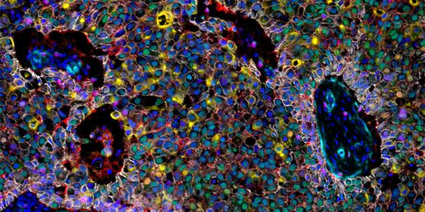High-plex spatial proteomics workflow for enhanced breast cancer research