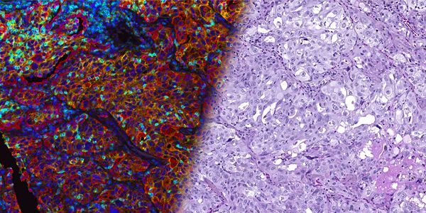 Spatially defining the future of cancer biology with advanced multiplexed immunofluorescence