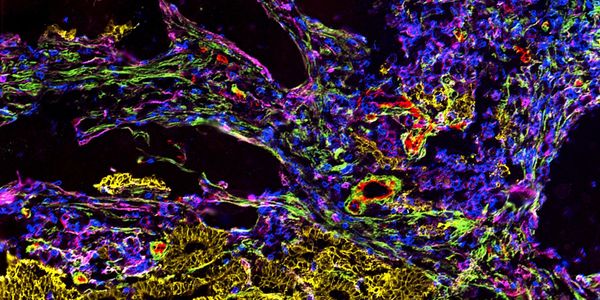 Next generation ultra high content analysis of the tumor immune microenvironment using MICS technology