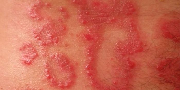 Cancer patients have a higher risk of getting shingles